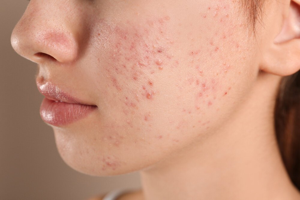 Teenage girl with acne problem on beige background, closeup