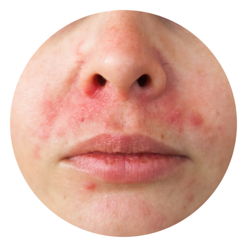 Read more about the article PERIORAL & PERIORIFICIAL DERMATITIS