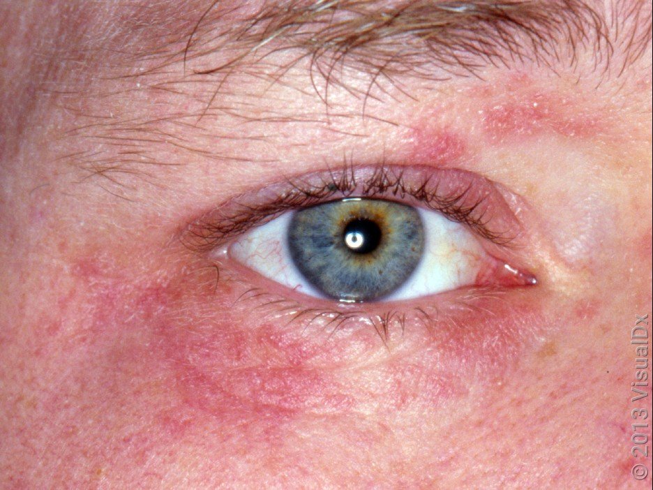 Perioral Dermatitis