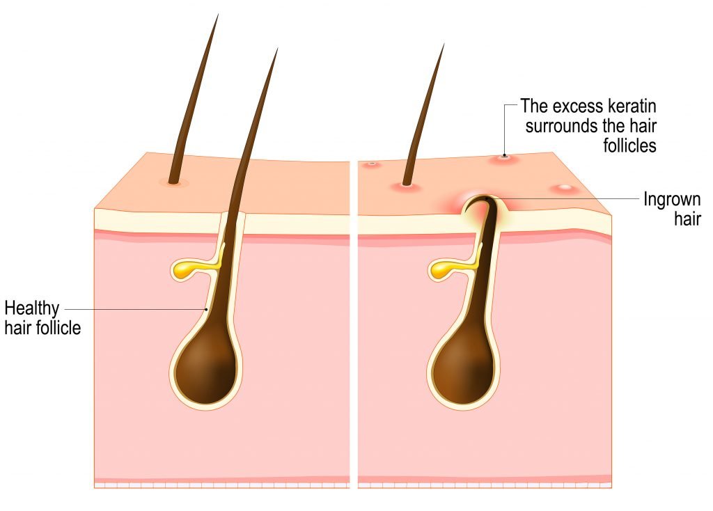 follicular hyperkeratosis face