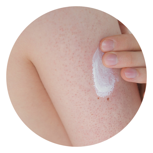 Read more about the article HELP! HOW CAN I GET RID OF KERATOSIS PILARIS?