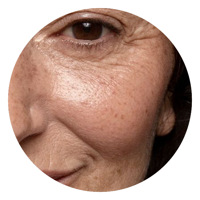 Read more about the article IS VITAMIN C AN EFFECTIVE TREATMENT FOR MELASMA?