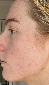 Uneven Skin Tone - Best Uneven Skin Tone Treatment Australia