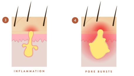 Acne+formation+2_