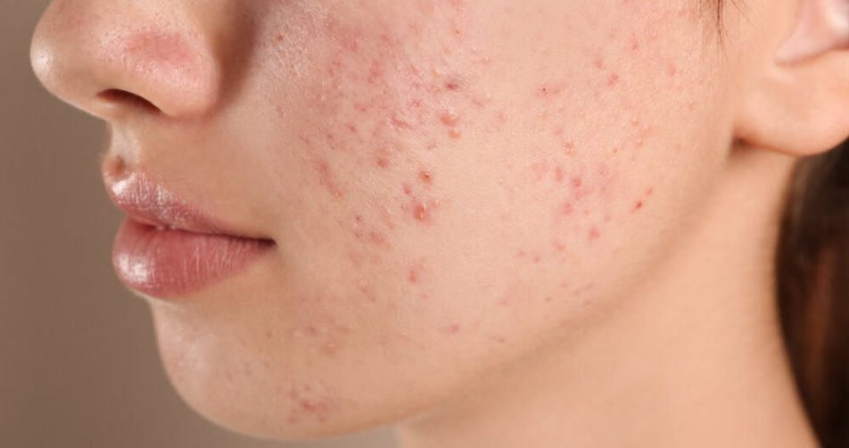 Teenage girl with acne problem on beige background, closeup