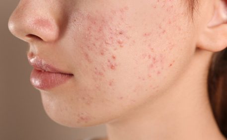 Teenage girl with acne problem on beige background, closeup