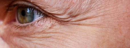 Procedure for the rejuvenation of wrinkles around the eyes, crow