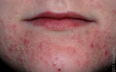 Perioral dermatitis with dry skin