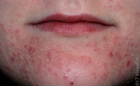 What Is Perioral Dermatitis? Symptoms, Causes, Diagnosis