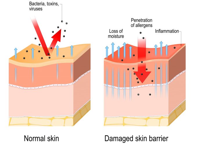 Skin Barrier